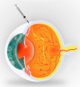 Image of injection of anti-VEGF